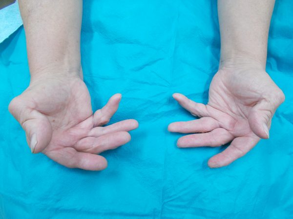 関節リウマチの身体所見